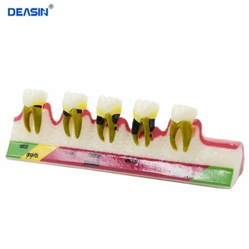 Dantų Dantų Modelį, Periodonto Ligų Assort Dantų Klasifikavimo Modelis